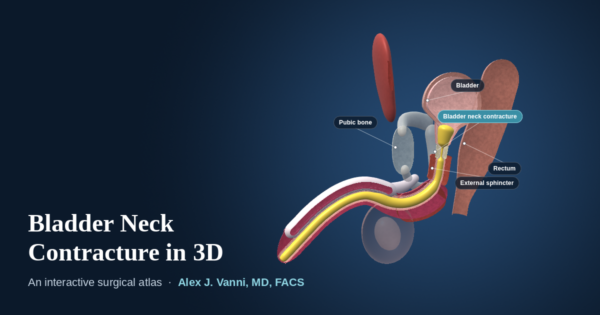 3D cutaway model of scar narrowing the bladder neck after prostate surgery