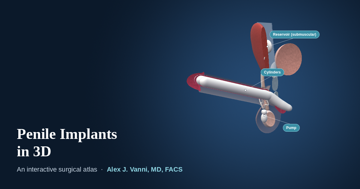 3D model of the penis with an inflatable penile implant, showing the cylinders, scrotal pump and submuscular reservoir
