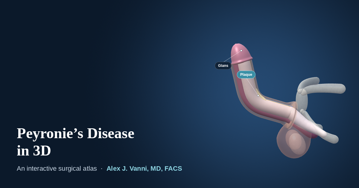 3D model of a penis with a 60 degree upward curve caused by a dorsal Peyronie's plaque