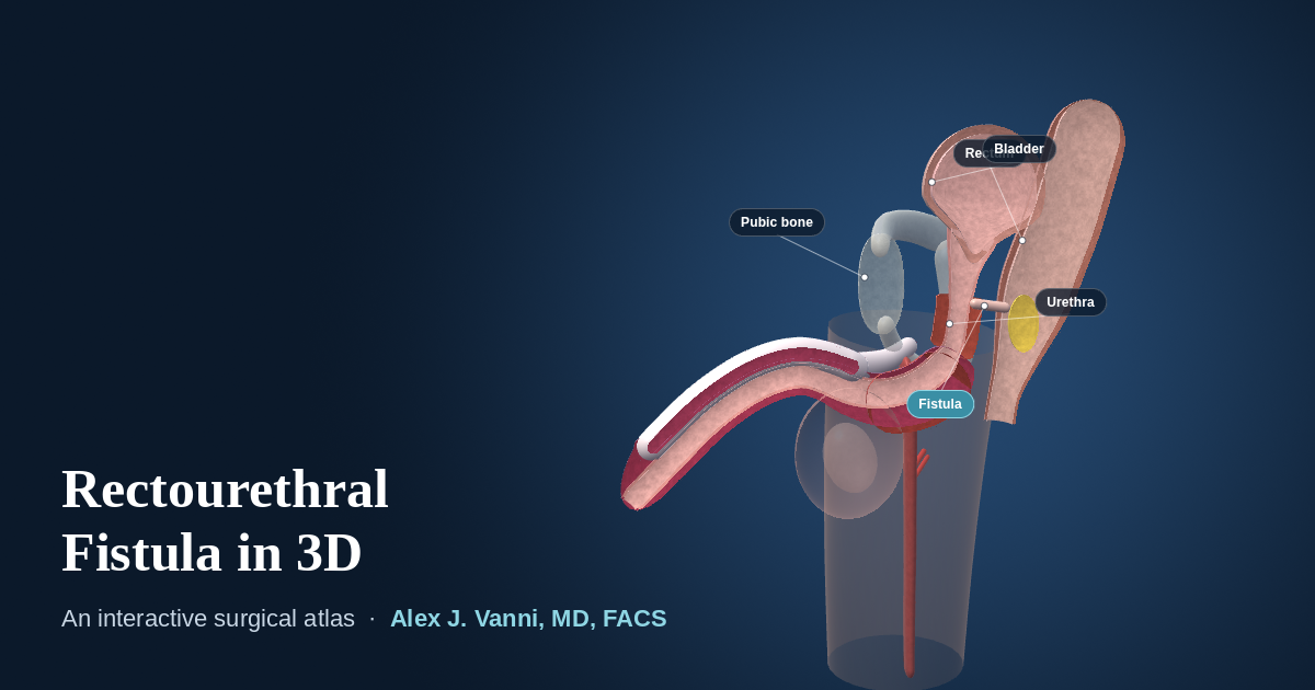 3D cutaway model of a fistula between the urethra and the rectum