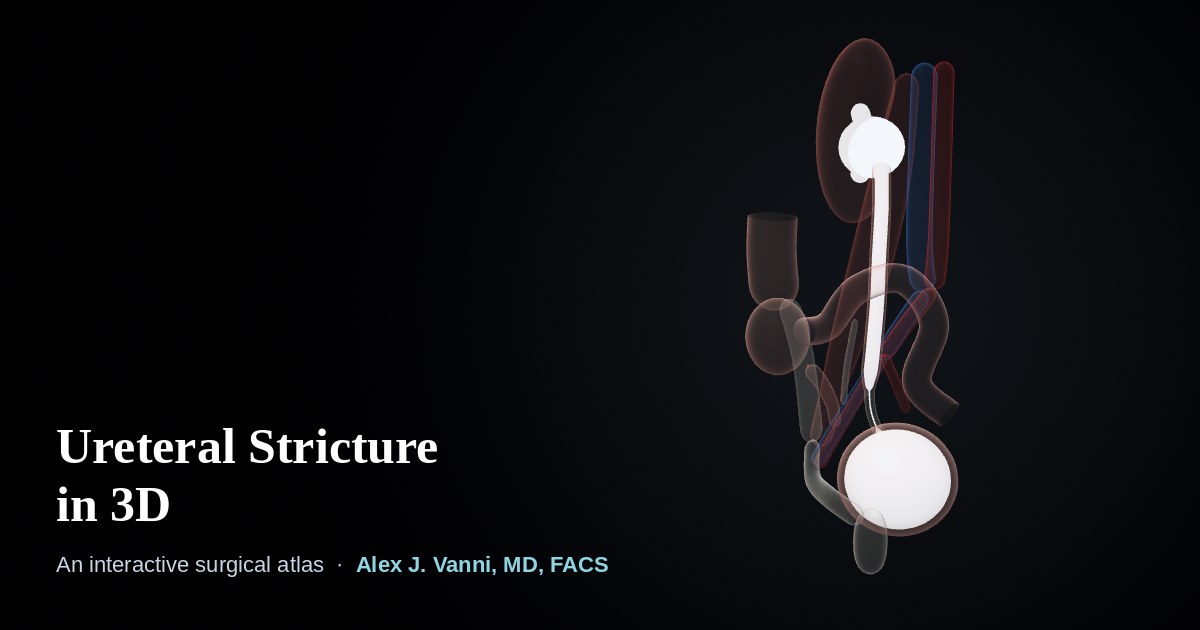 3D X-ray view of the kidney, ureter and bladder showing a narrowing in the lower ureter