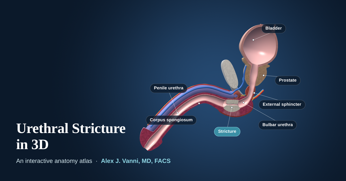 Interactive 3D cutaway model of the male urethra showing a stricture in the bulbar urethra